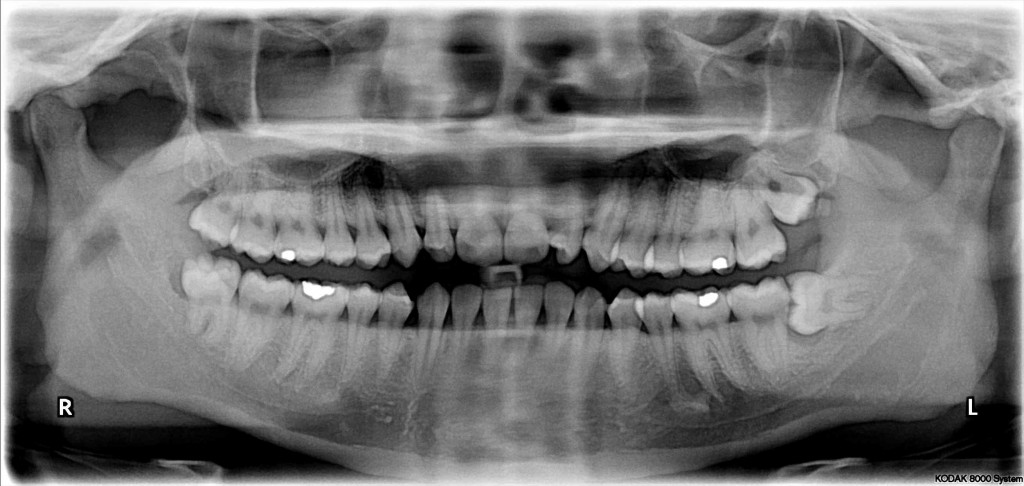 Vestigial organs - wisdom teeth