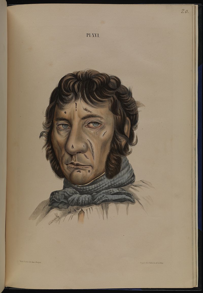Leprosy in Art - man aged 40 1800s